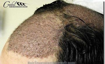 Hair restoration procedure results