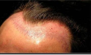 Hair restoration procedure results