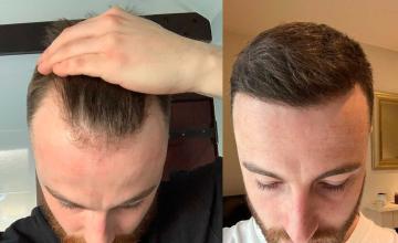 Front before and after FUE surgery