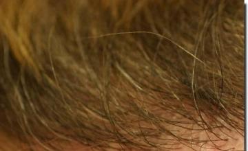 Hair restoration procedure results