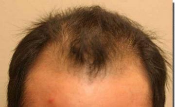 Hair restoration procedure results