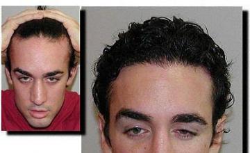 Hair restoration procedure results