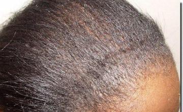 Hair restoration procedure results