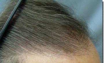 Hair restoration procedure results