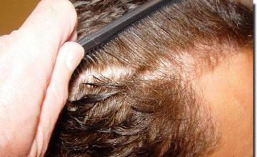 Hair restoration procedure results