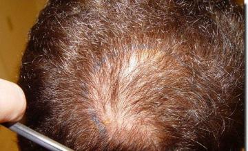 Hair restoration procedure results