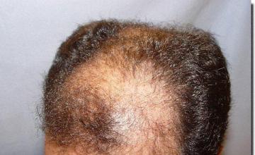 Hair restoration procedure results