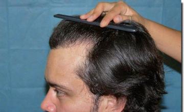 Hair restoration procedure results