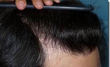 Hair restoration procedure results