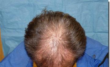 Hair restoration procedure results