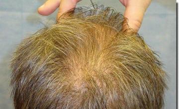 Hair restoration procedure results