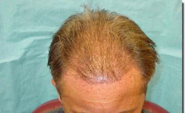 Hair restoration procedure results