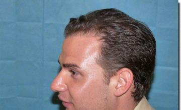 Hair restoration procedure results