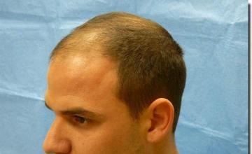 Hair restoration procedure results