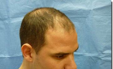 Hair restoration procedure results