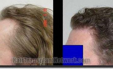 Hair restoration procedure results