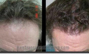 Hair restoration procedure results