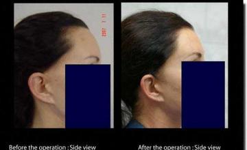 Hair restoration procedure results