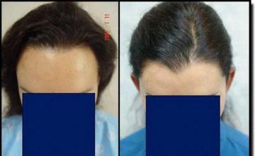 Hair restoration procedure results