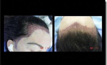 Hair restoration procedure results