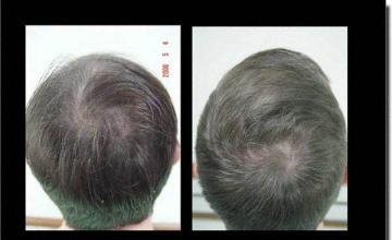 Hair restoration procedure results