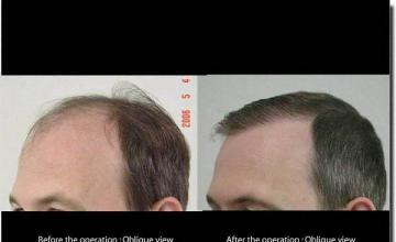 Hair restoration procedure results