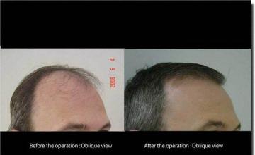 Hair restoration procedure results