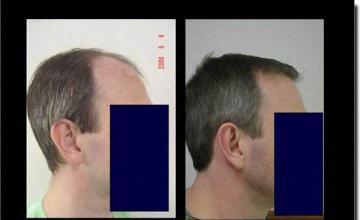 Hair restoration procedure results