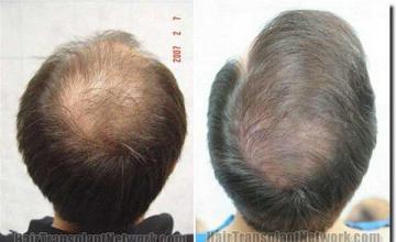 Hair restoration procedure results