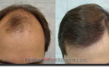 Hair restoration procedure results