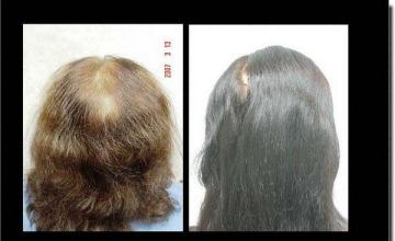 Hair restoration procedure results