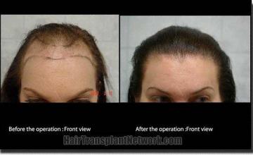 Hair restoration procedure results