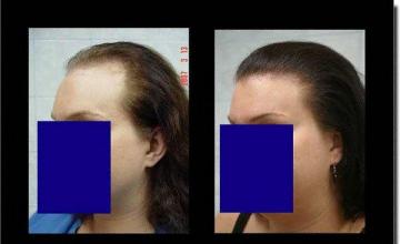 Hair restoration procedure results