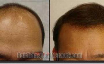 Hair restoration procedure results