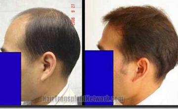 Hair restoration procedure results