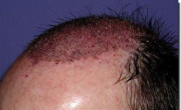 Hair restoration procedure results