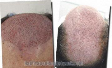 Hair restoration procedure results