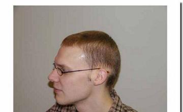 Hair restoration procedure results