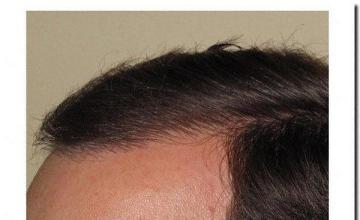 Hair restoration procedure results