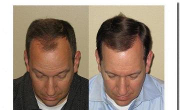 Hair restoration procedure results