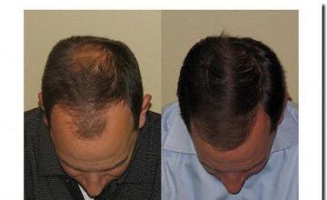 Hair restoration procedure results