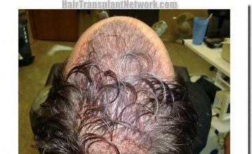 Hair restoration procedure results