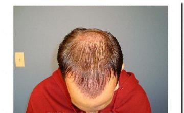 Hair restoration procedure results