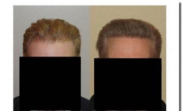 Hair restoration procedure results