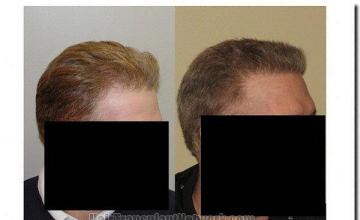 Hair restoration procedure results