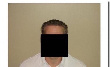 Hair restoration procedure results