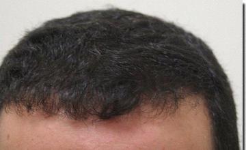 Hair restoration procedure results