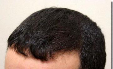 Hair restoration procedure results