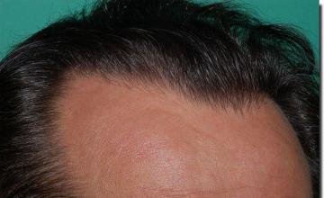 Hair restoration procedure results