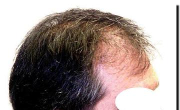 Hair restoration procedure results